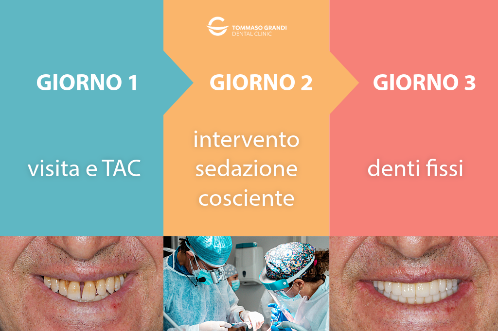 Tempistiche per riavere denti fissi con impianto a carico immediato rispetto alla rigenerazione ossea.