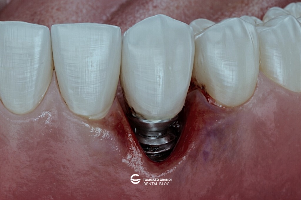 Infezione impianto dentale: sintomi, cosa fare e quando è urgente