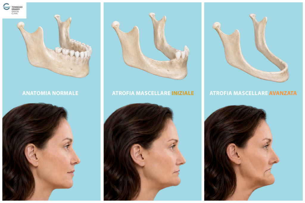 Atrofia mascellare - Tommaso Grandi Dental Clinic