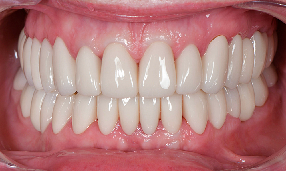 Faccette dentali dopo, Tommaso Grandi Dental Clinic