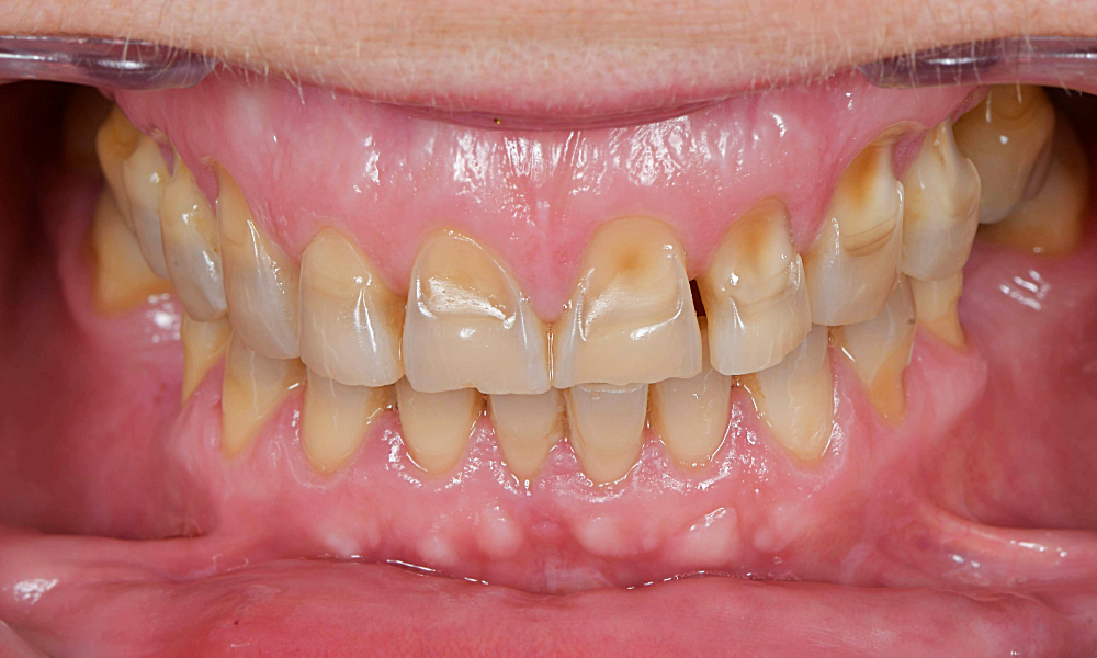 Faccette dentali prima, Tommaso Grandi Dental Clinic