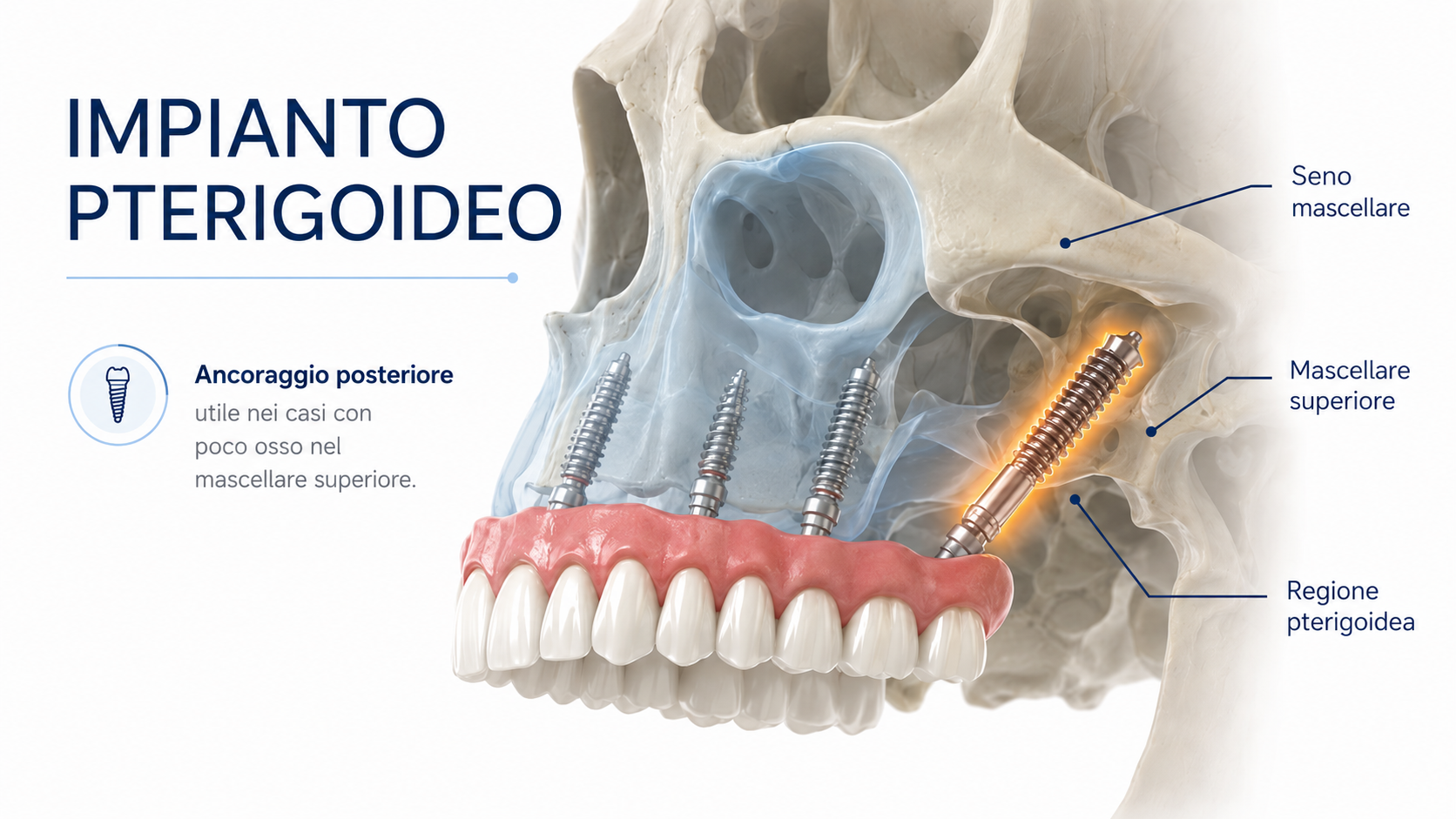 impianto Pterigoideo che cos'è?